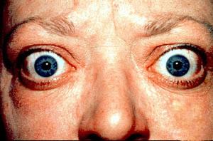 Image: Graves ophthalmopathy by Jonathan Trobe, M.D.. License: CC BY 3.0 Graves ophthalmopathy includes proptosis (exophthalmos), periorbital edema, conjunctivitis and diplopia.