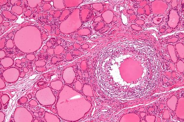 Image: Granuloma in subacute thyroiditis by Nephron. License: CC BY-SA 3.