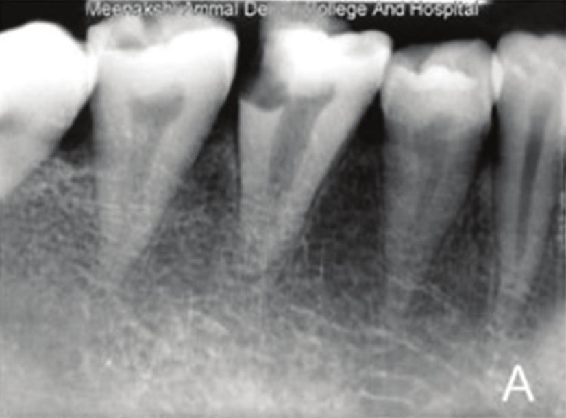 2 Case Reports in Dentistry (a) (b) (c) (d) Figure 1: (a) Preoperative radiograph showing the posterior teeth with single root. (b) Access opening demonstrating single. (c) Working length radiograph.