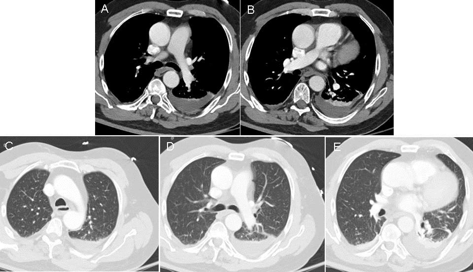 1. A normal chest x-ray in a hospitalized hypoxic patient should prompt a search for a pulmonary embolism. The post-operative portable chest x-ray is fairly unremarkable.