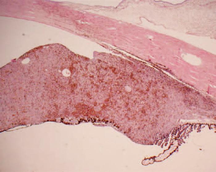 Figure 1. Three cases of presumed iris melanosis or freckles.
