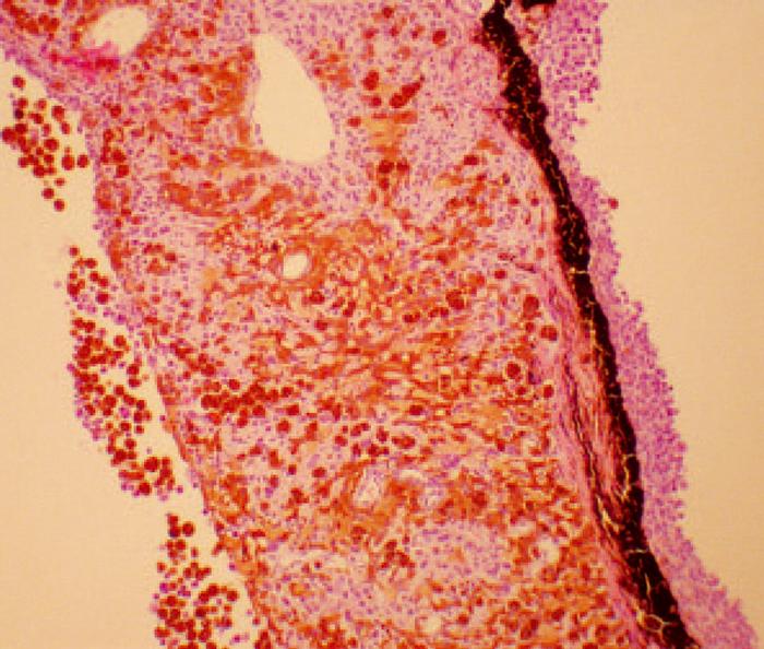 Figure 3. Photomicrograph of FDIM. Pigmented neoplastic cells are found on the iris surface and throughout the iris stroma.