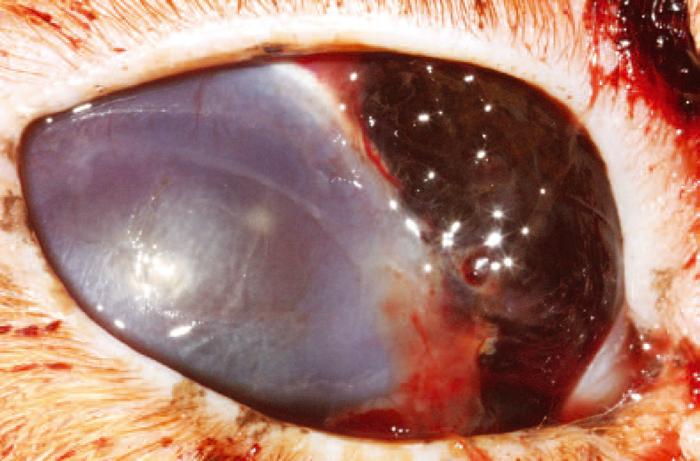 Figure 5. Secondary glaucoma caused by aggressive FDIM.