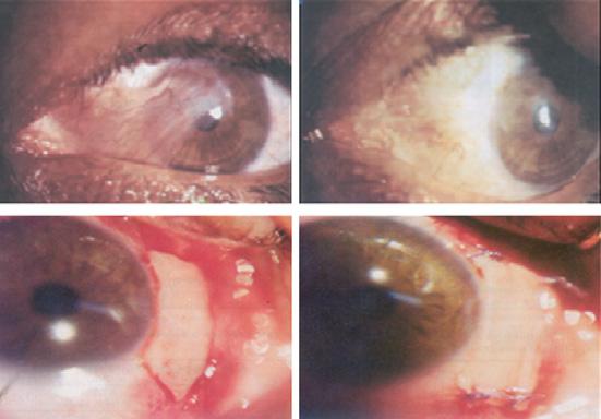 The recurrence of pterygium after different modalities of surgical treatment 413 Figure 1 Top (patient of group 1) top left: recurrent pterygium and top right: 6 months after limbal autograft.