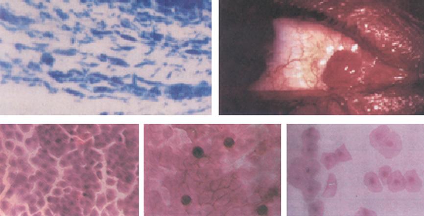 Recurrence was considered when fibro vascular tissue regrowth over the cornea clinically (Fig. 3, top left).