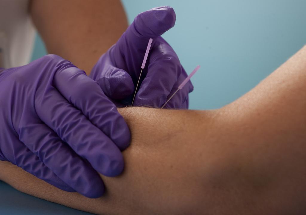 Clinical Interests Alternative Therapy Trigger-Point Dry Needling The National Jewish Health Rehabilitation Department now offers trigger-point dry needling (TPDN) as an alternative therapy for