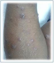 2. Presence of a disease known to be associated with PG (usually listed as IBD, polyarthritis, myelodysplasia or leukaemia, monoclonal gammopathy; overall about 50% have an associated systemic