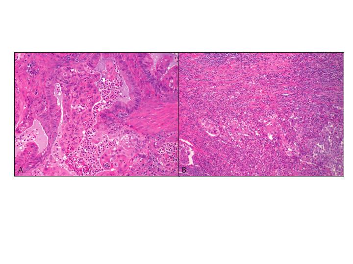 2 / CAP TODAY A Fig. 1. The patient s endometrial carcinoma showing (A) mucinous and squamous differentiation and (B) dense peri- and intratumoral lymphocytic infiltration (H&E, magnification 20 ).