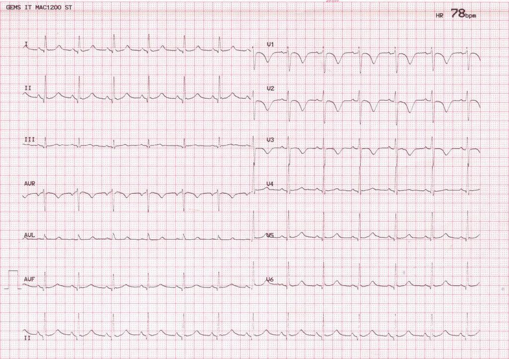 Case 2 The ECG after fibrinolysis showed reduction of