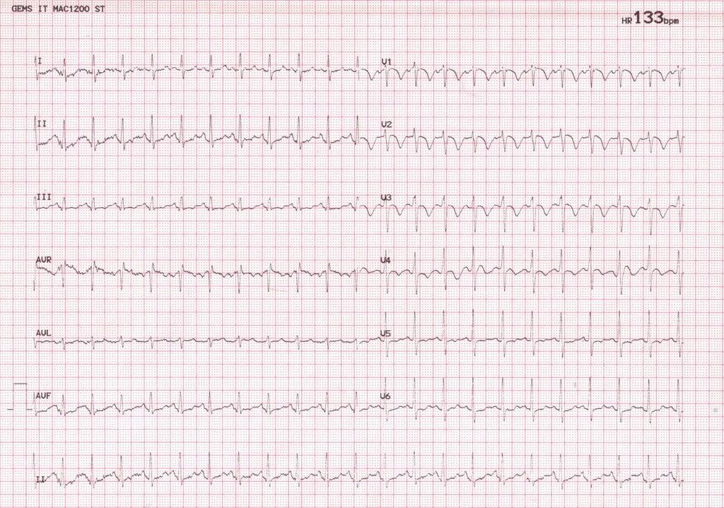 Case 2 Admission ECG showed sinus tachycardia, deep