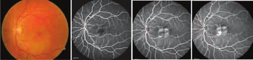 Role of OCT Angiography in Diabetic Retinopathy Study evaluating OCT Angiographic picture in Diabetic Retinopathy by Akihiro et al 18 described microaneurysms as dilated saccular or fusiform