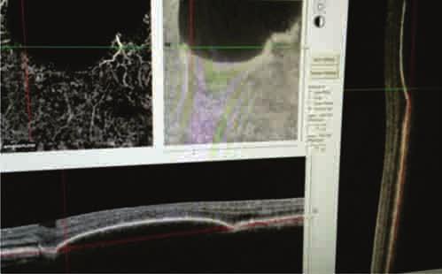 With OCT angiography, layers can be dissected arbitrarily any time after acquisition to obtain flow based images.