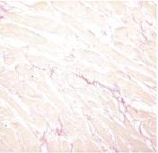 Collagen volume fractino (%) MYOCARDIAL FIBROSIS IN