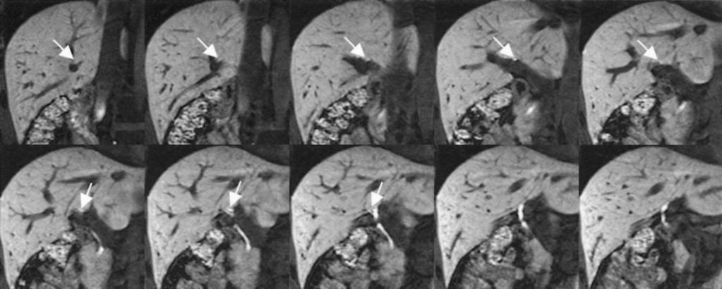 T1-weighted coronal enhanced T1-MRC shows right posterior segmental duct (white arrow) draining aberrantly into proximal left hepatic duct through serial image review from