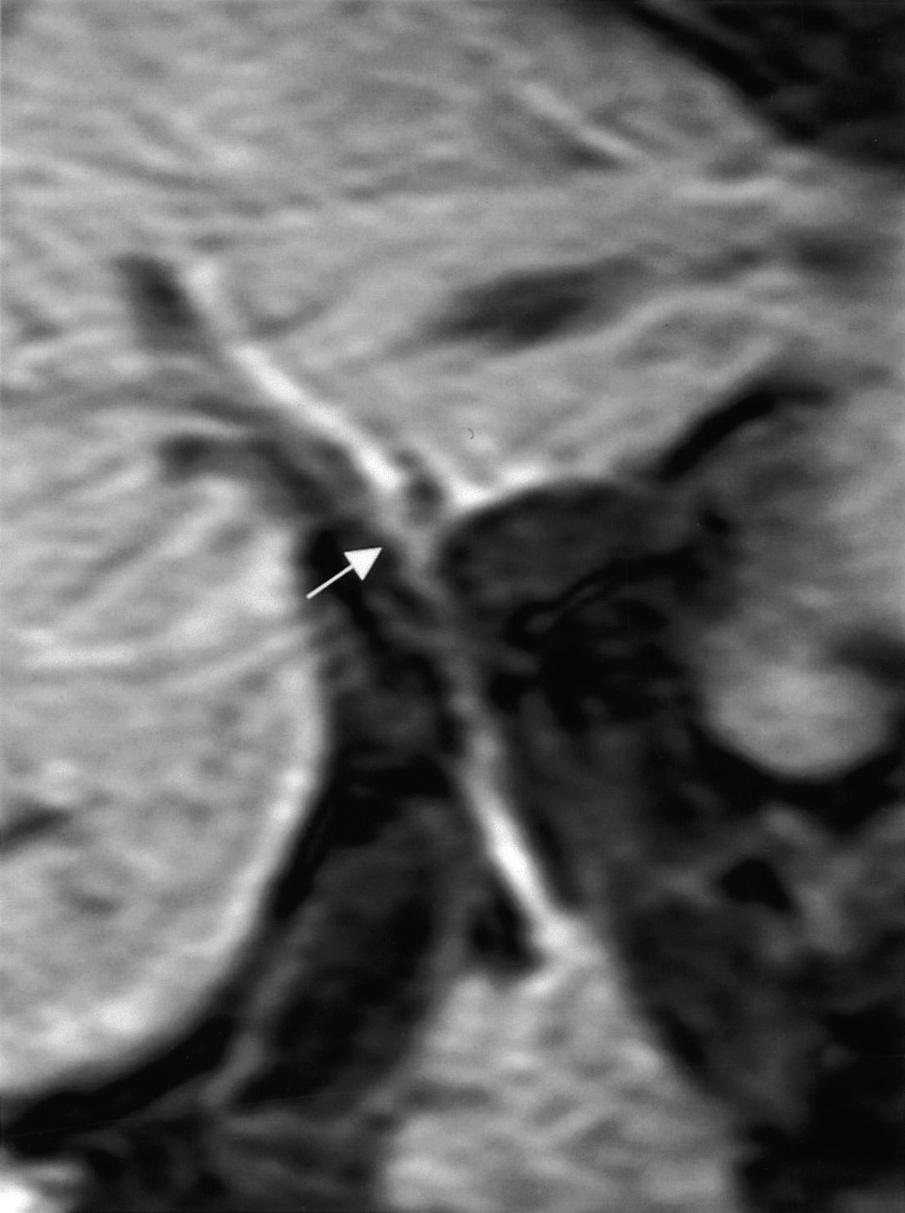 Unfavorable trifurcation pattern that single anastomosis cannot be performed. A.