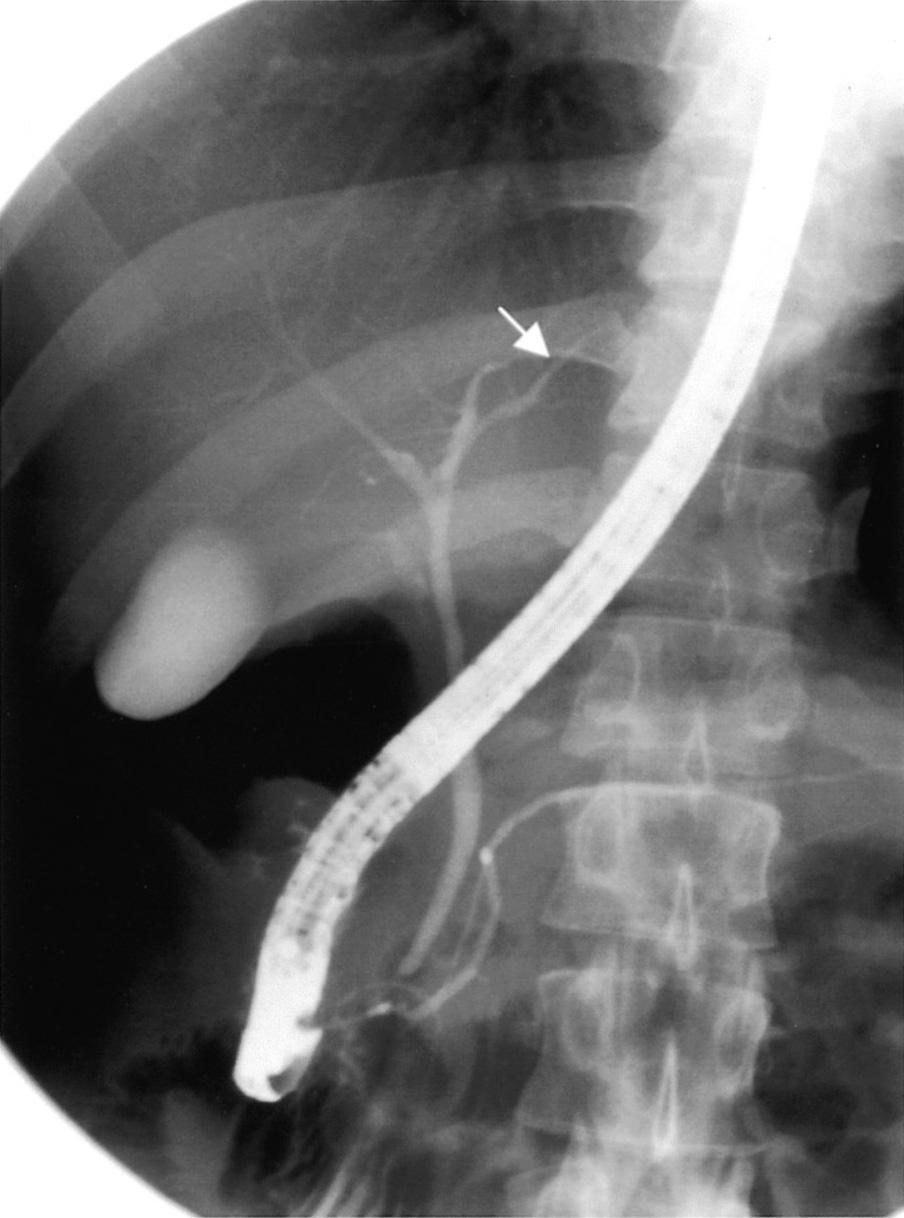 30-mm thickness) depicts a branch (white arrow) off right hepatic duct.