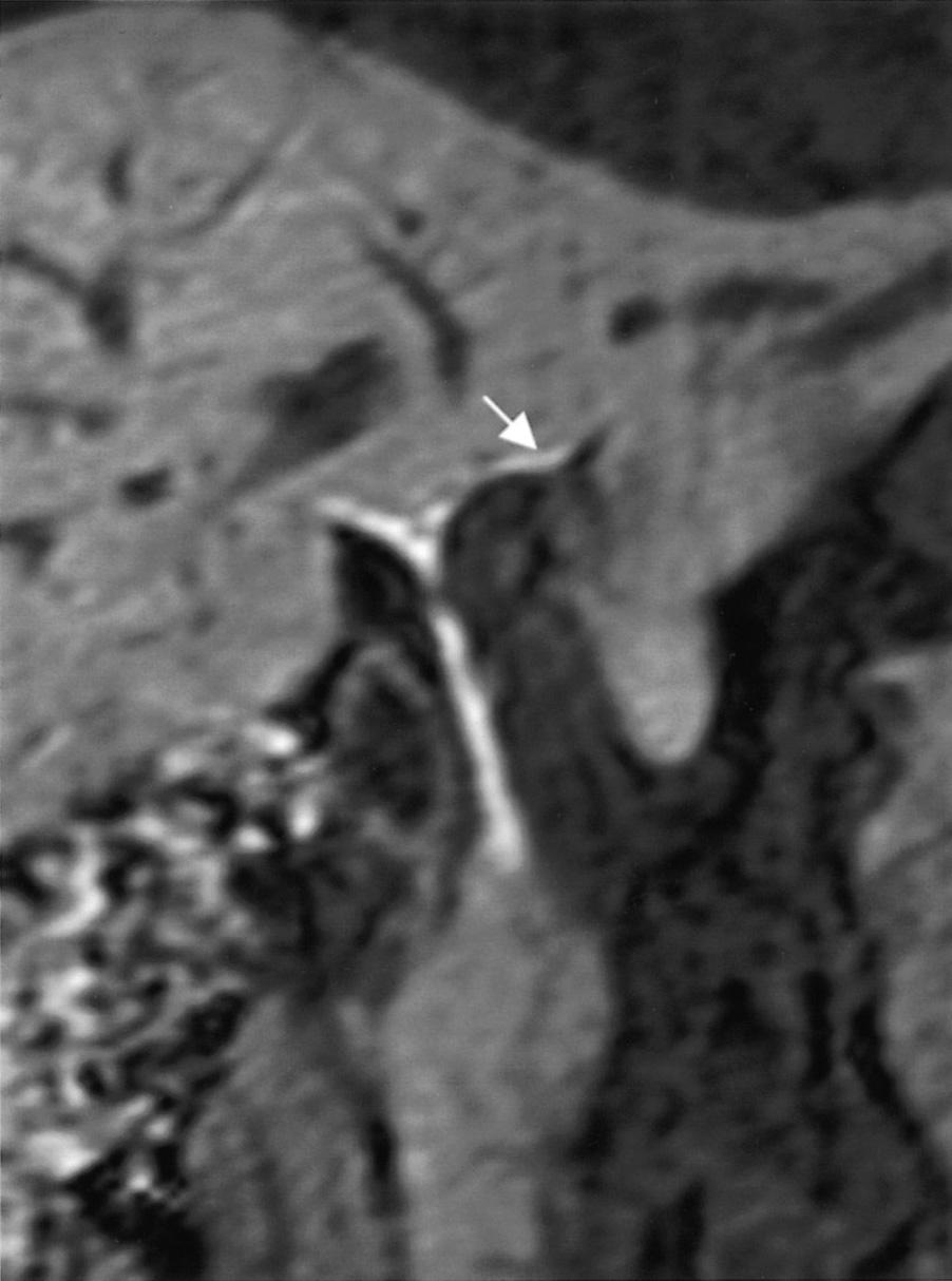 segmental duct (white arrow) to right hepatic duct pattern (B is