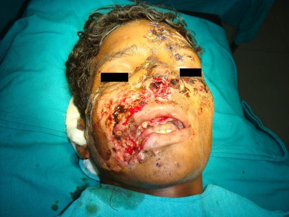 CASE REPORT A young male patient aged 18 years, presented to our oral and maxillofacial consultation one week after a road traffic accident.