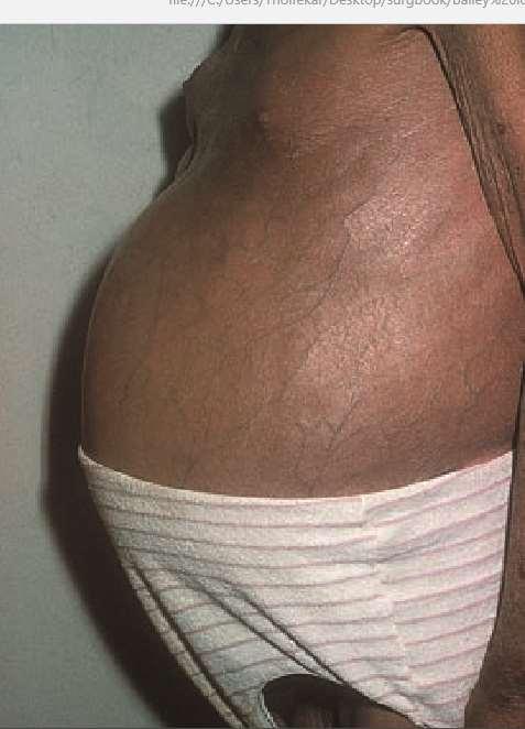 A patient with endstage liver cirrhosis disease,