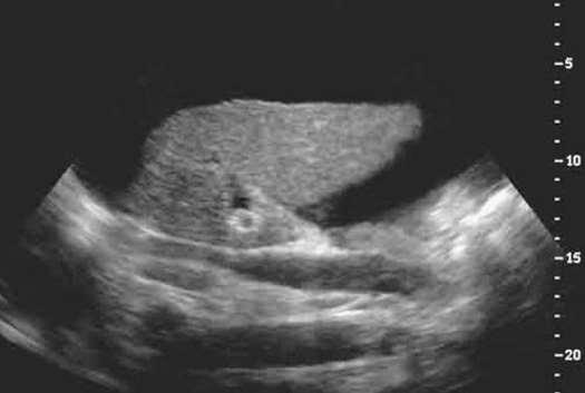 Sagittal ultrasound image of the liver in a patient with cirrhosis