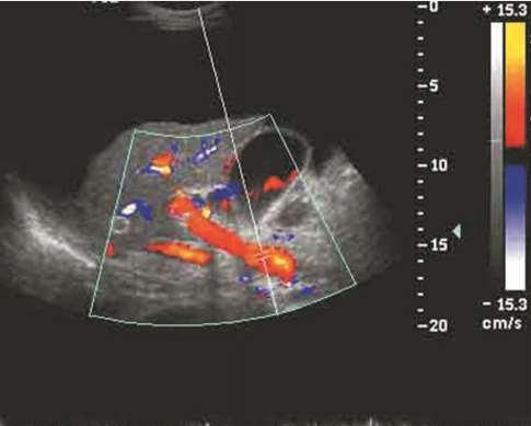 Doppler ultrasound illustrates