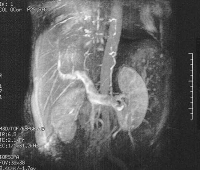 Magnetic resonance imaging (MRI) scan showing massive hepatosplenomegaly.