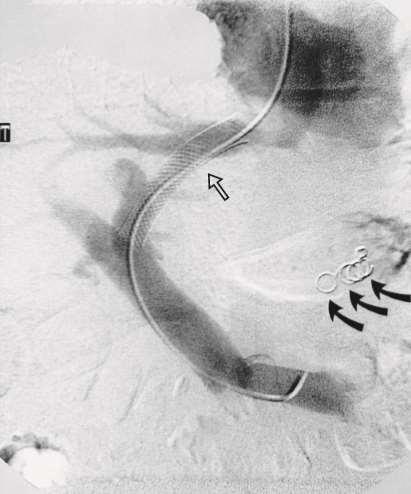 The angiogram following insertion of a transjugular intrahepatic portosystemic stent shunt (open arrow).