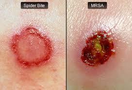 MRSA (cont d) Prehospital Staph infections, including MRSA, generally start as small red bumps that resemble pimples, boils, or some spider bites Can quickly turn into