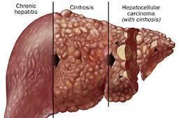 Hepatitis B (cont d) Prehospital Most signs and symptoms of Hep B mild Unlikely you will be called to respond to acute illness