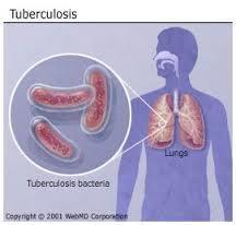 Tuberculosis (TB) Caused by small bacteria that travels from small airways to cells of the lungs Less than 10% of people infected with TB