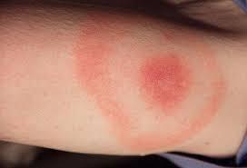 West Nile Virus (cont d) Transmission WNV is transmitted through the bite of an infected mosquito.