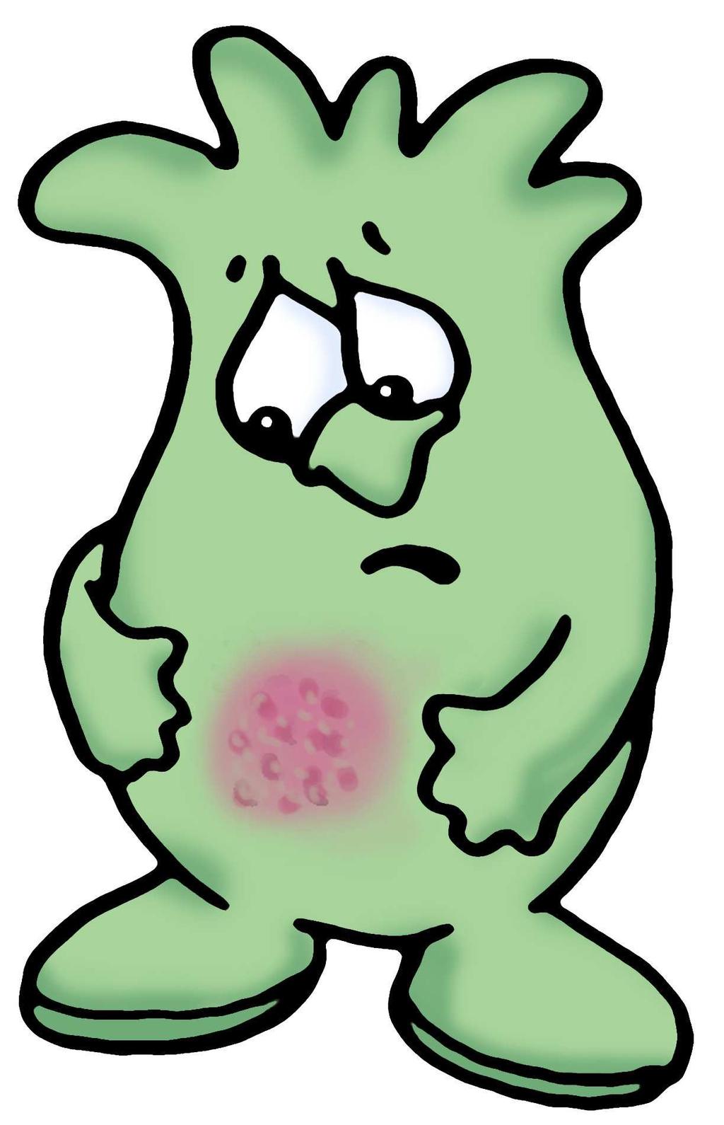 MRSA May appear as pustules or boils which may be red, swollen, painful, or have pus or other drainage Often first look like spider bites or bumps