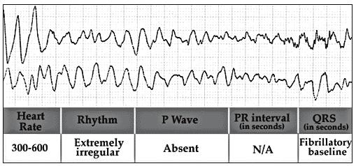 61 Ventricular fibrillation (VFIB) is a condition in which the heart's electrical activity becomes disordered as shown in Figure 5.2.