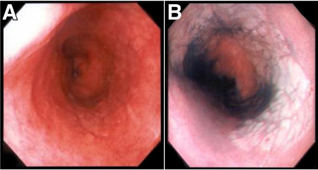 844 LONGCROFT WHEATON ET AL CLINICAL GASTROENTEROLOGY AND HEPATOLOGY Vol. 8, No. 10 Figure 1. HGD in Barrett s pre- (A) and post (B) AA dye spray. sent for data collection.
