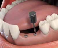the patient s mouth, making sure that the top of the transfer screw is