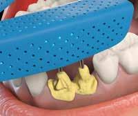 Release the long screws and remove the tray from the patient s mouth.