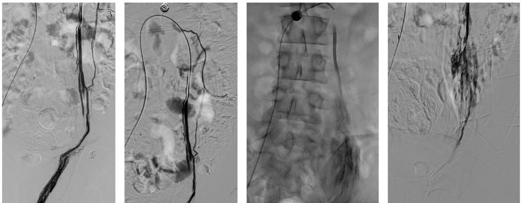 Mohamed M. El-Rakhawy 1481 (A) (B) (C) (D) Fig. (1): A case of left side varicocele treated by transjugular route. (A) Initial angiogram shows the left renal vein and spermatic vein origin.
