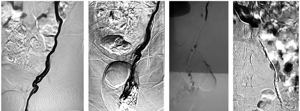 (D) Post embolization image show dense NBCA along the left spermatic vein up to the collaterals level. (A) (B) (C) (D) Fig. (2): A case of left side varicocele treated by transfemoral route.