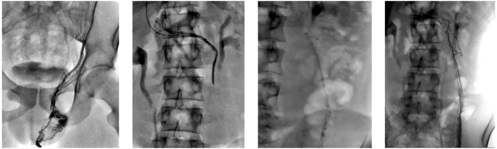 (C) Left spermatic vein angiogram show contrast leak within small hematoma at the mid-portion of the spermatic vein (D) Post embolization image show dense NBCA along the left spermatic vein at the