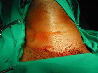 Pharyngobranchial duct 3 rd and 4 th Branchial Cleft Anomalies Presentation Cyst