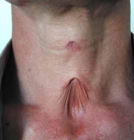 Midline Cervical Cleft It is not a "true" cleft, as it does