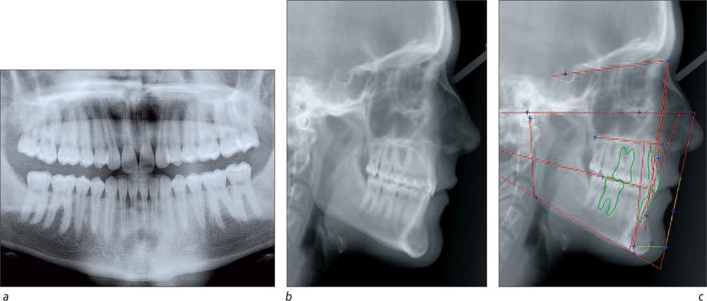 d to f: intra-oral right, anterior, left views, 06/11 (21y 3m). Figures 20a to 20c T.1. Post-treatment 7 ½ years later.
