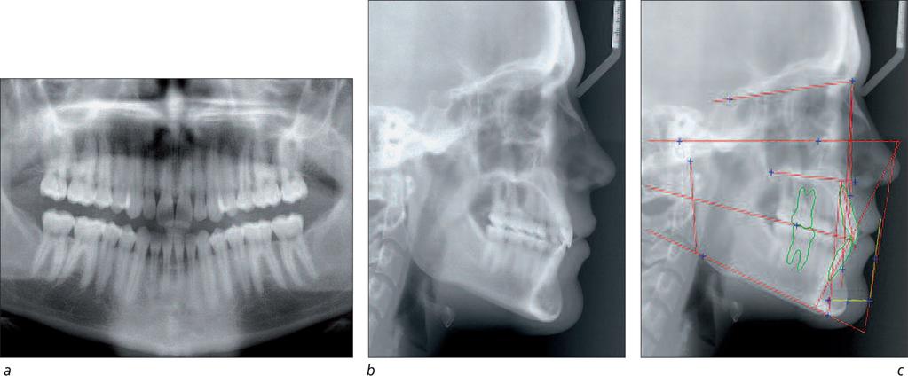 a to c: profile, smile, frontal at rest portraits, 06/09 (19y 3m); d to f: intra-oral right profile, anterior, left, 06/09 (19y 3m);