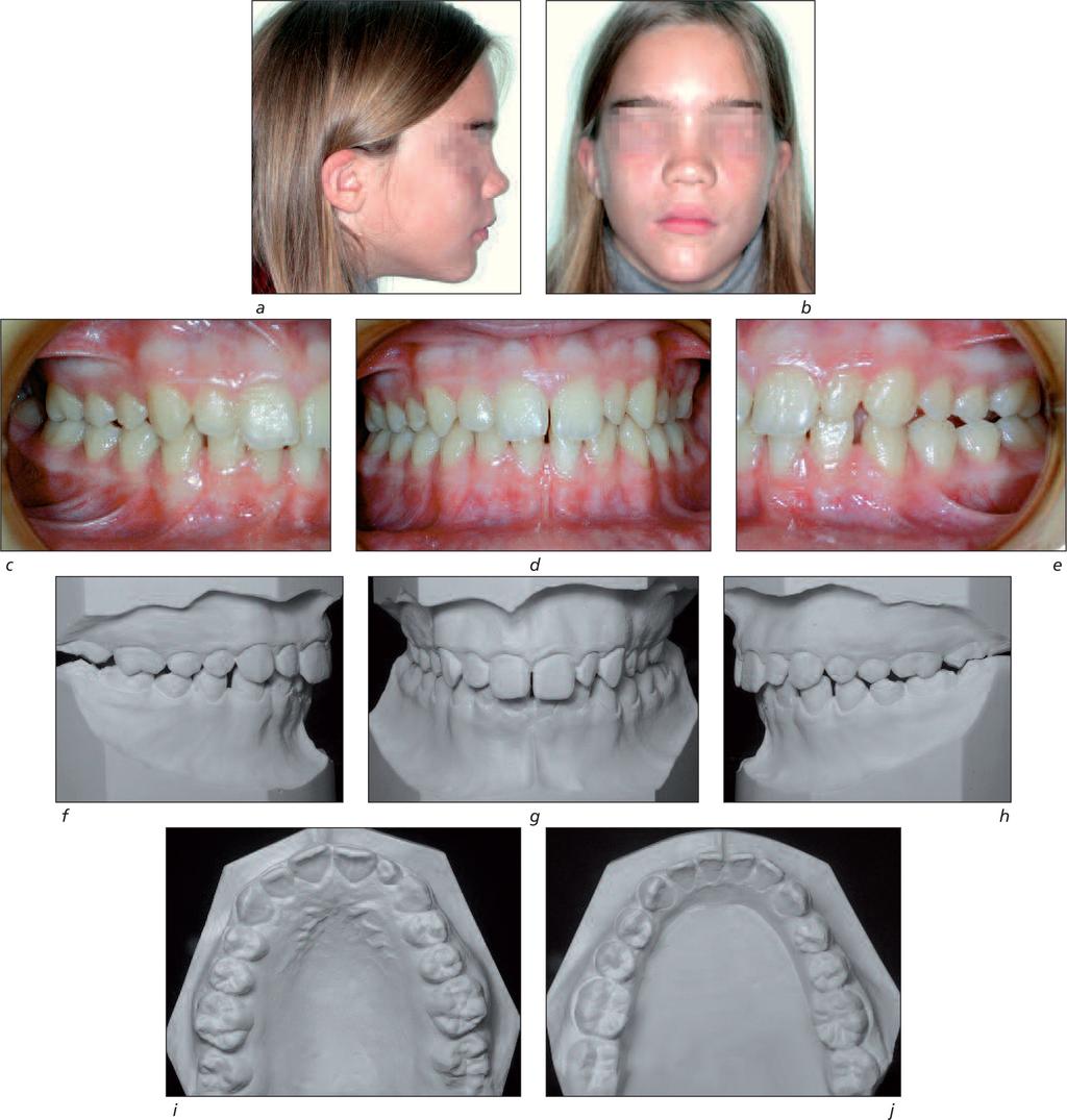 REGARDING MORPHOLOGICAL DIFFERENCES OF THE MAXILLARY ANTERIOR TEETH OF MONOZYGOTIC TWIN SISTERS Figures 2a to 2j T.