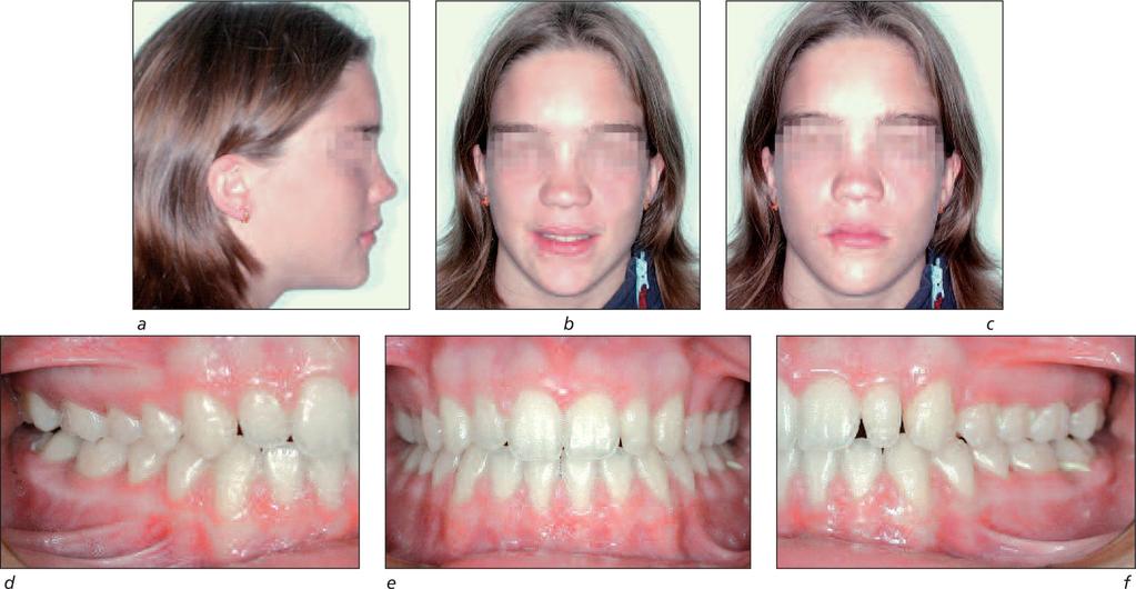 a to c: profile, smile, frontal at rest portraits, 02/04 (13y 11m); d to f: intra-oral, right, anterior, left