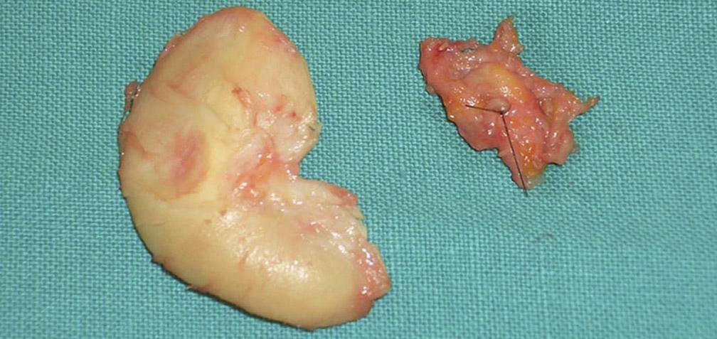 The Journal of Craniofacial Surgery & Volume 21, Number 1, January 2010 Perichondrium Graft TECHNIQUE The harvesting of conchal cartilage is carried out by means of a retroauricular approach so as to