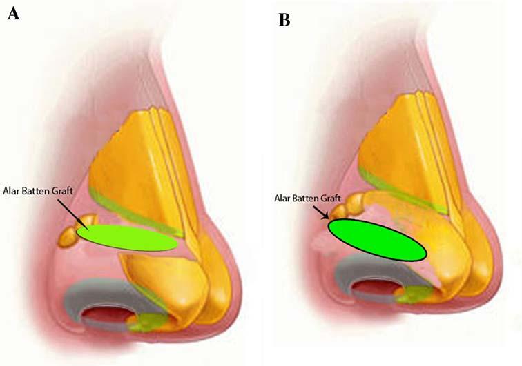 626 Aesth Plast Surg (2009) 33:625 634 Fig. 1 a The alar batten graft for correction of internal nasal valve collapse.