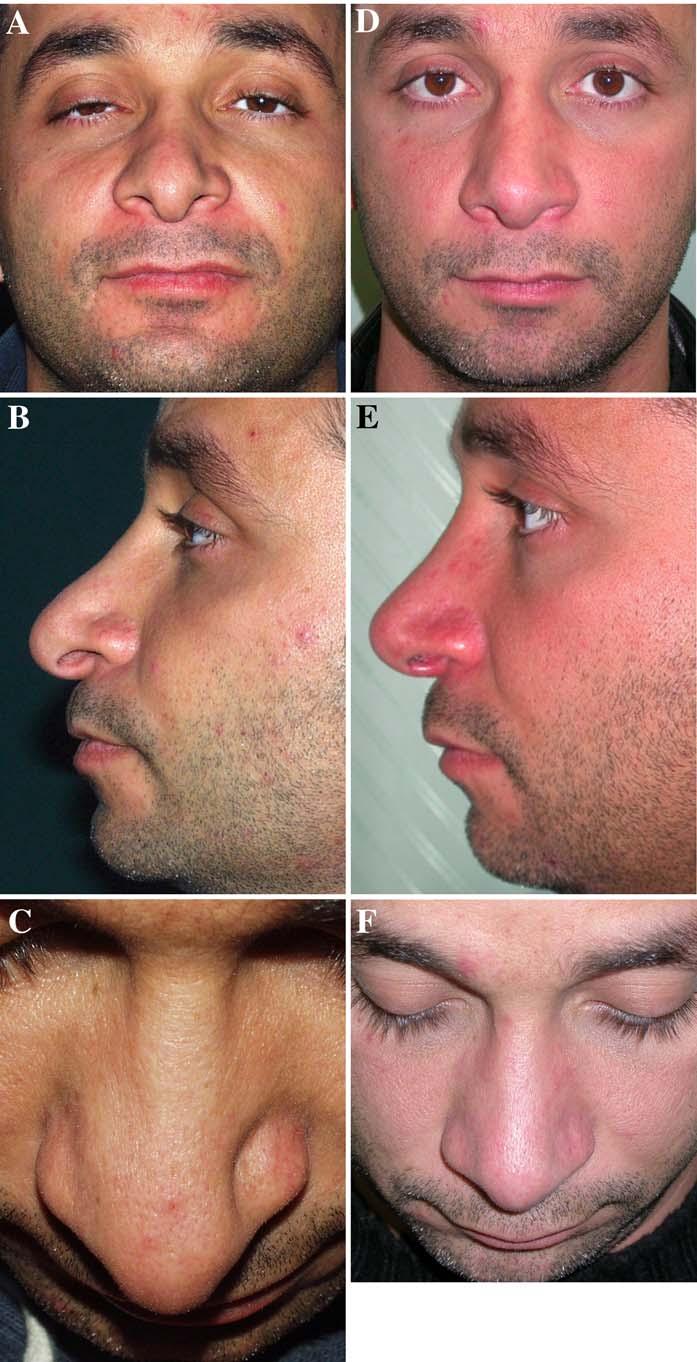 630 Aesth Plast Surg (2009) 33:625 634 Fig. 10 Patient who underwent previous reductive rhinoplasty and suffered from severe iatrogenic nasal valve collapse of the right rim. a c Preoperative views.