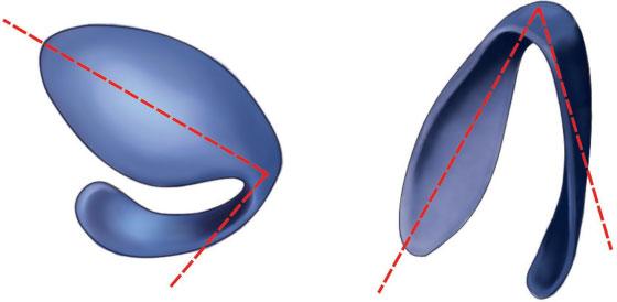 340 Foda Fig. 1 Right: horizontal domal angle. Left: vertical domal angle between long axis of intermediate and lateral crura. the subsequent placement and fixation of soft triangle grafts.