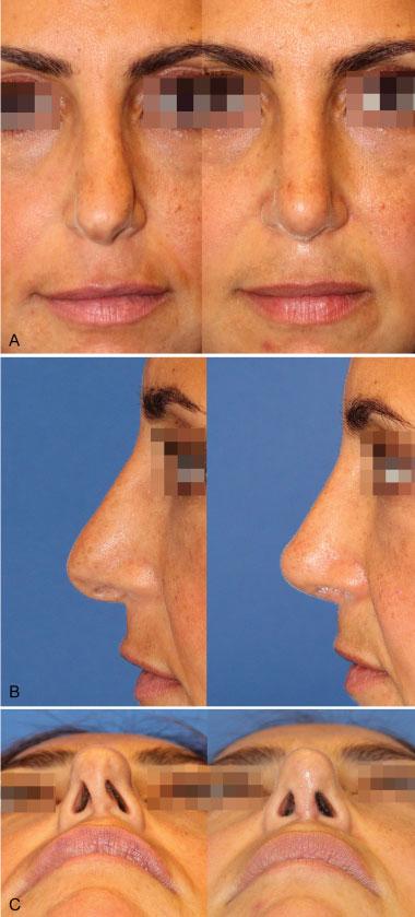 Discussion TheSTtriangleisoneoftheareasthatisusuallyleftunattended in most rhinoplasties. Its appearance is critical to maintaining the natural contour of the nasal tip lobule.
